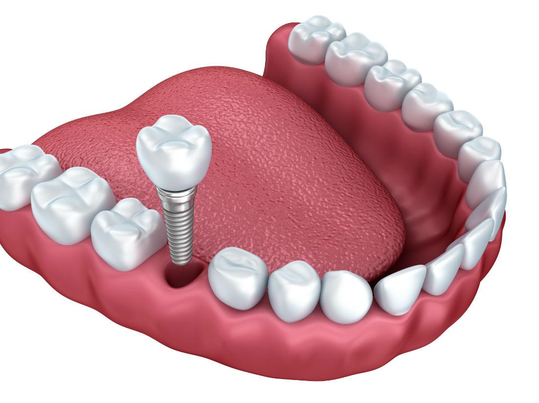 Dental Implants Merced CA