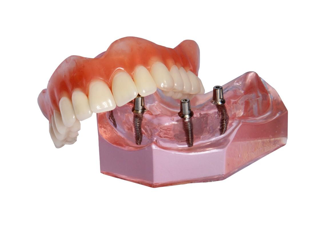 Dental Implants Merced, CA